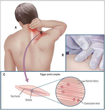 Dry Needling Belvidere IL