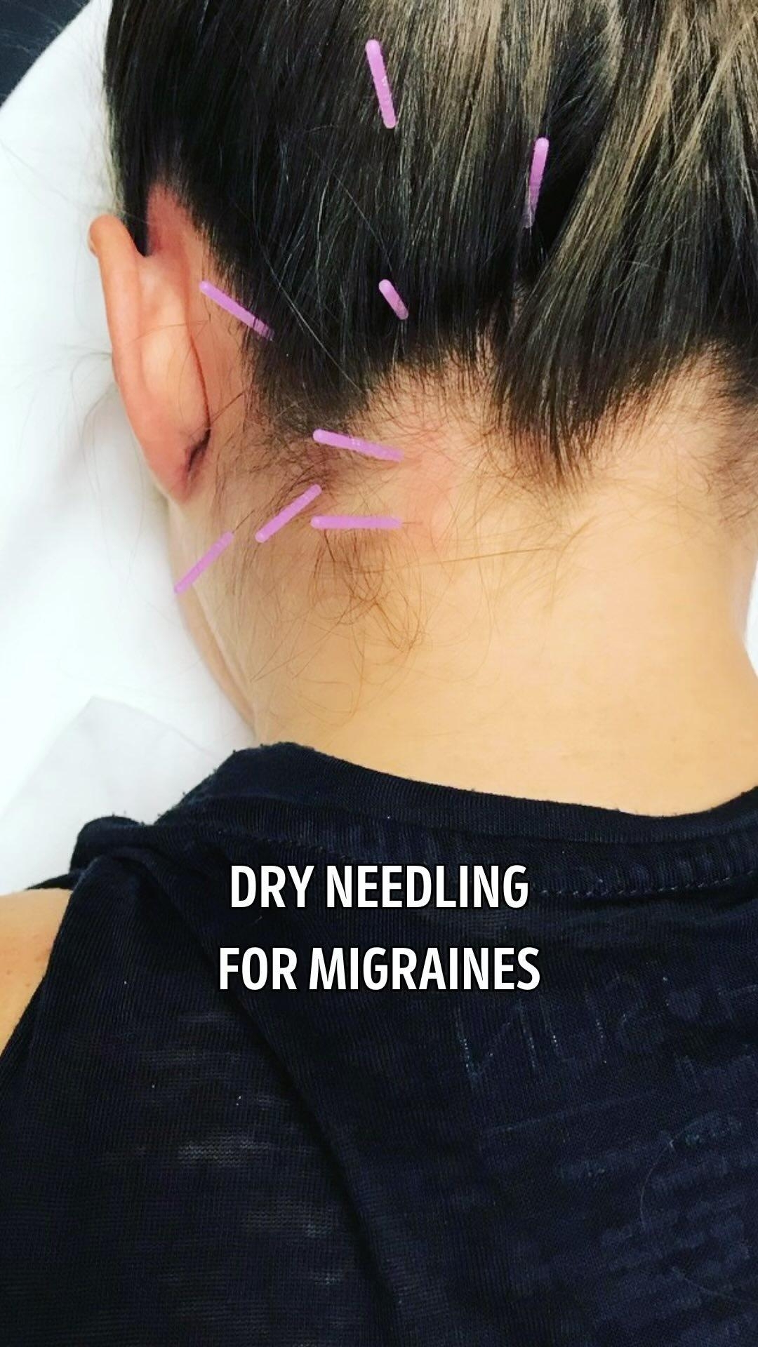 Dry Needling Byron IL