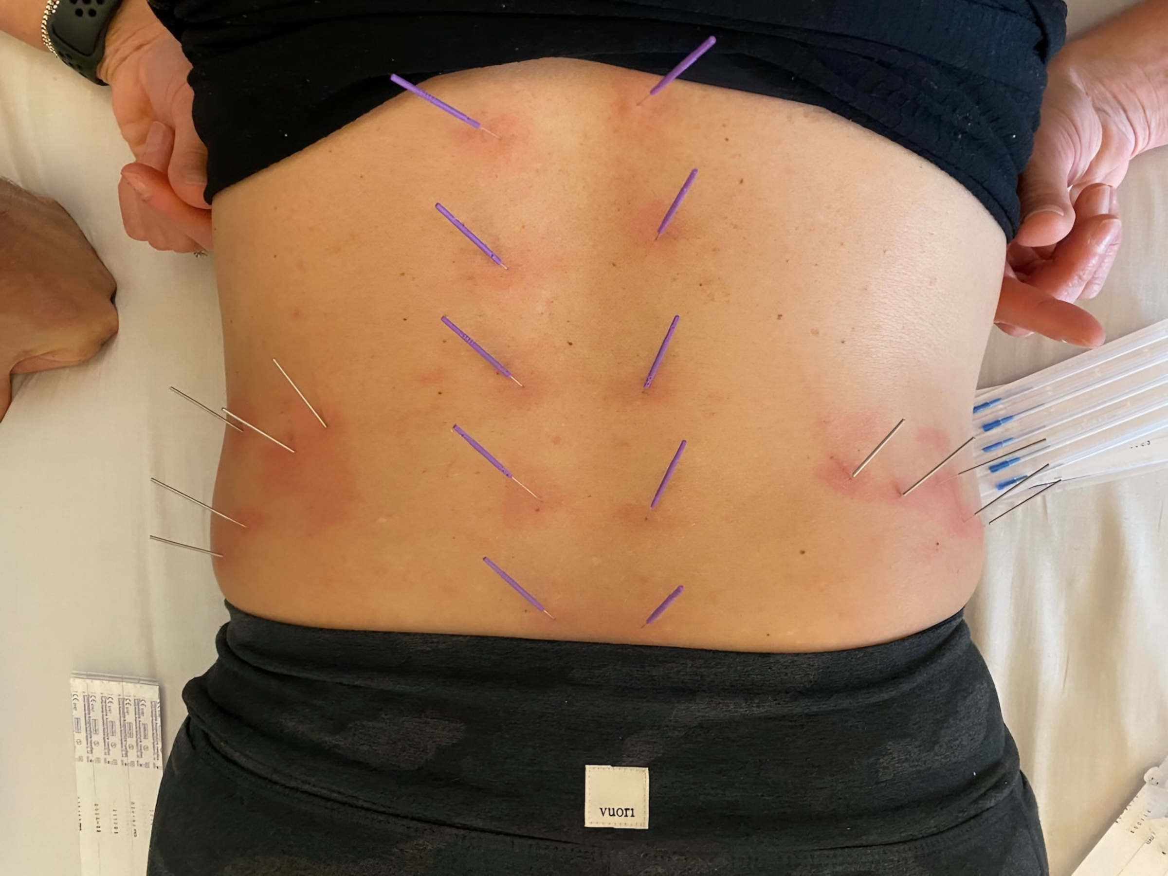 Dry Needling Dixon IL