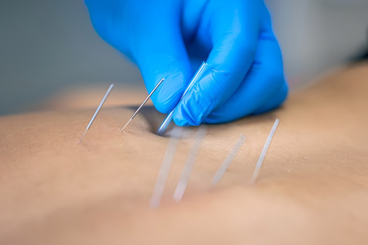 Dry Needling Orthopedic Rehab Specialists Rockford