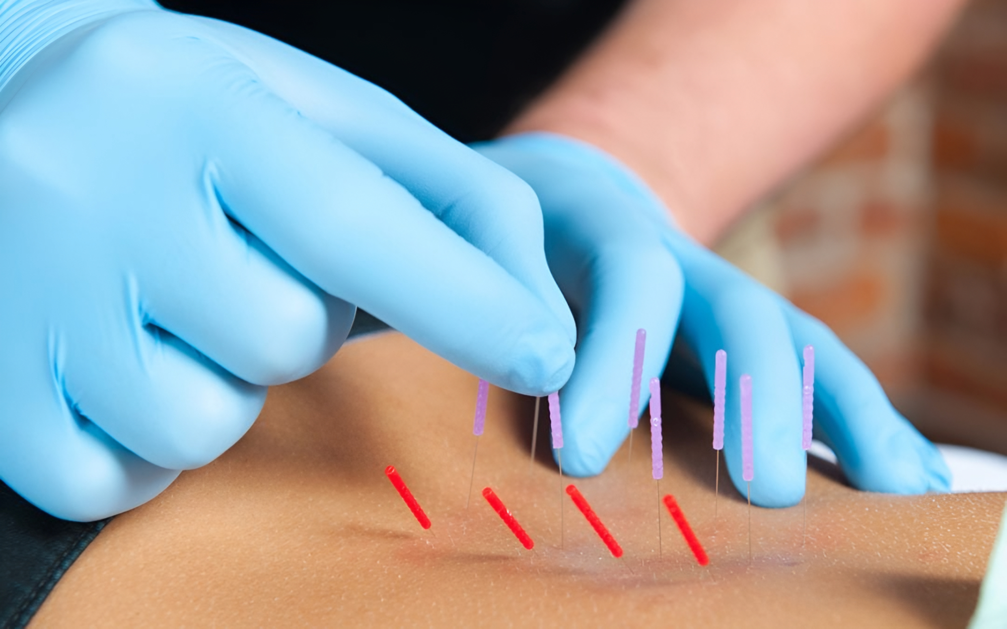 Dry Needling Rockford IL