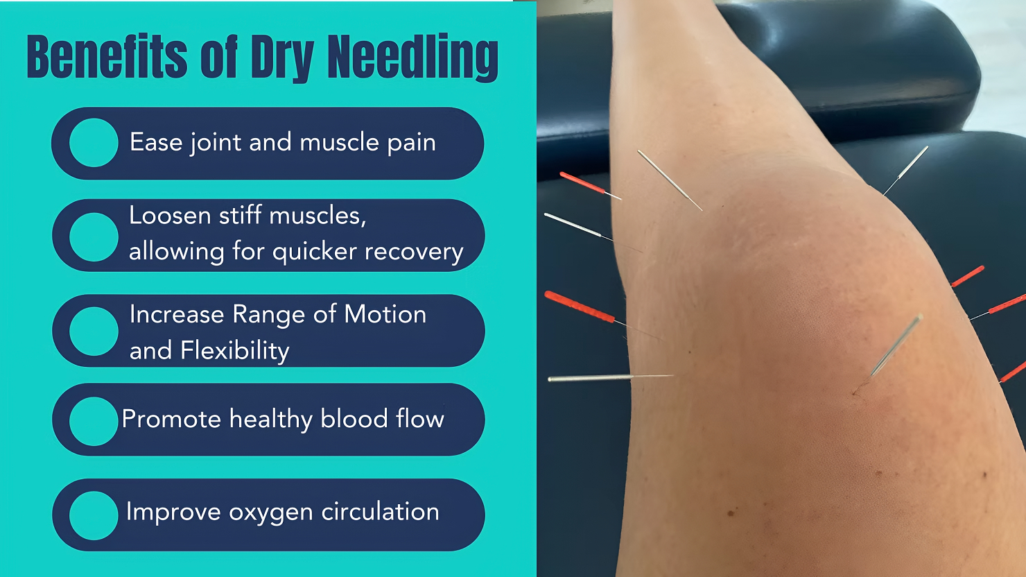 Dry Needling Roscoe IL