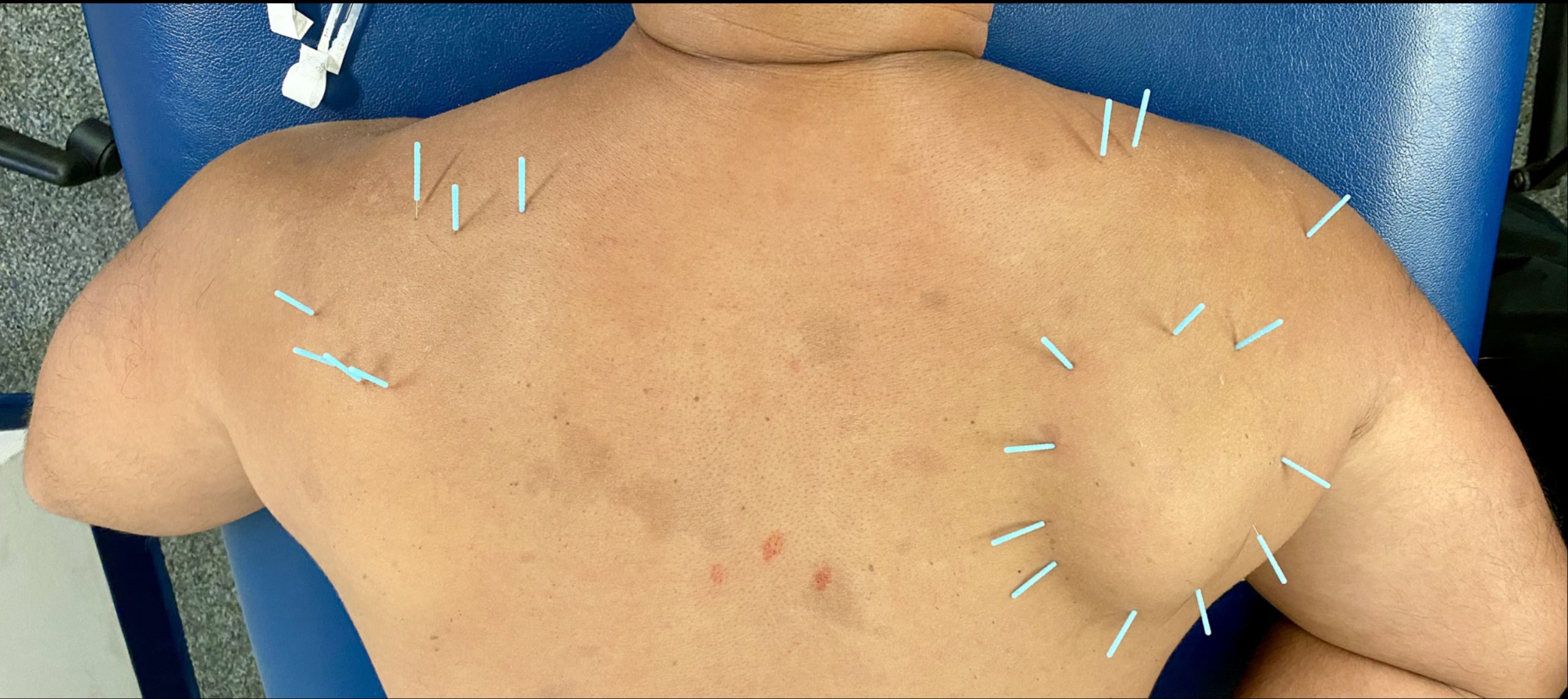 Dry Needling Services Rockford